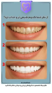 کامپوزیت ونیر